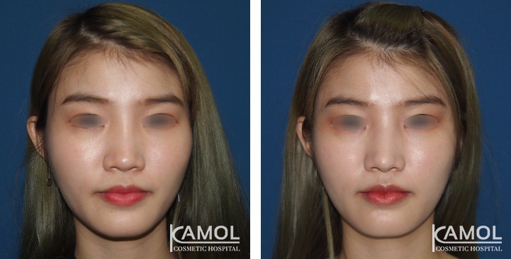 Before and After Augmentation Rhinoplasty, Nose Job, Nose Surgery  with e-PTFE Gore-Tex