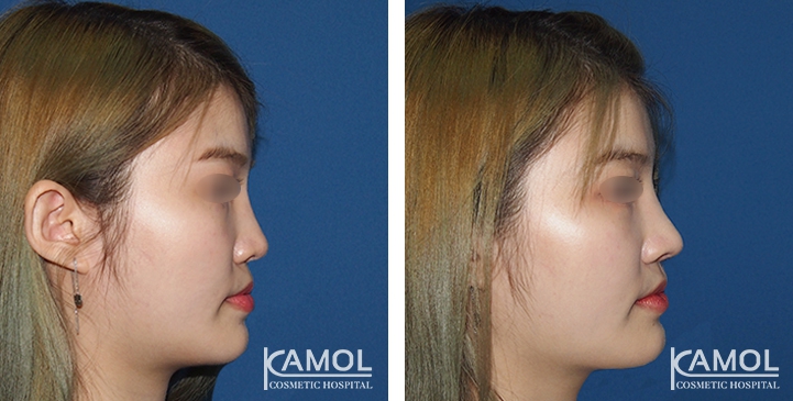 Before and After Augmentation Rhinoplasty, Nose Job, Nose Surgery  with e-PTFE Gore-Tex