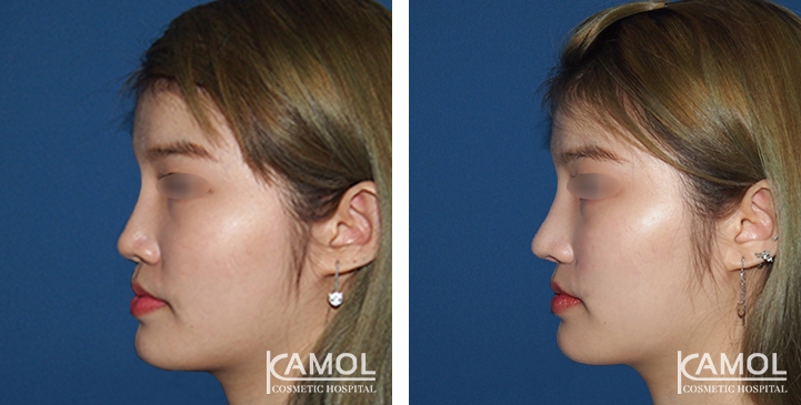 Before and After Augmentation Rhinoplasty, Nose Job, Nose Surgery  with e-PTFE Gore-Tex