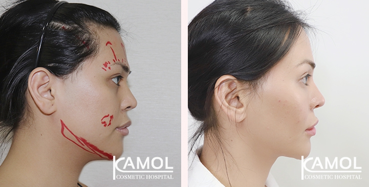 Jaw reduction, Forehead contouring, Eye brow lift