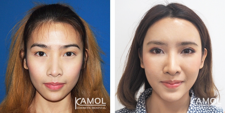 Double eyelid surgery