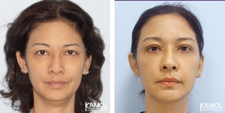 Lower Eyelid Surgery