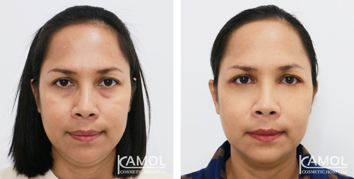 Lower Eyelid Surgery