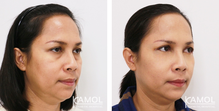 Lower Eyelid Surgery