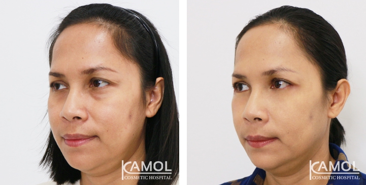 Lower Eyelid Surgery