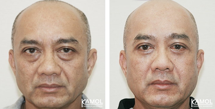 Lower Eyelid Surgery