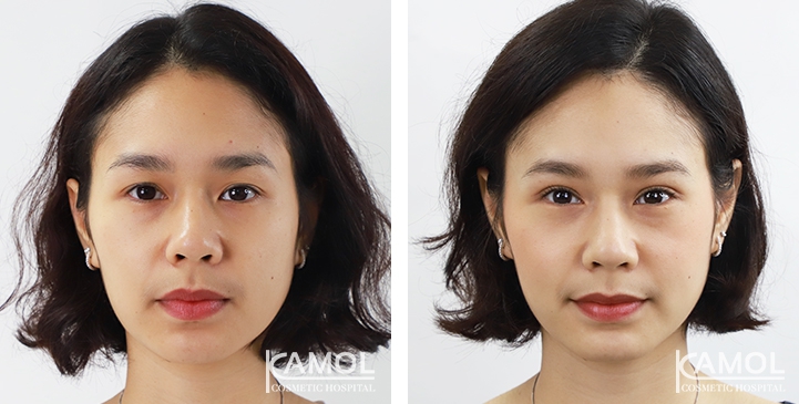 Lateral Canthoplasty