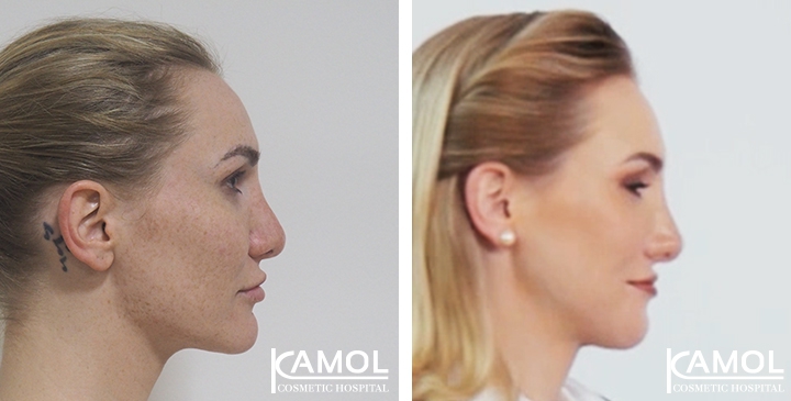 Before and After 1 month surgery, Jaw to Chin Reduction, Revision Rhinoplasty