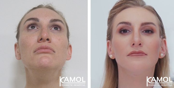 Before and After 1 month surgery, Jaw to Chin Reduction, Revision Rhinoplasty