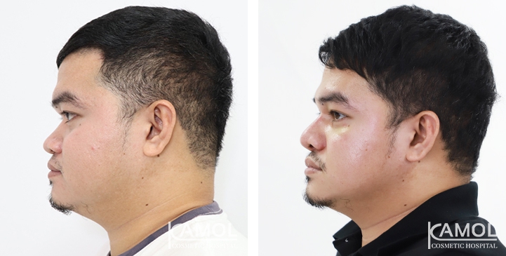 Before and After Augmentation Rhinoplasty, Nose Job, Nose Surgery