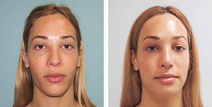 Before and After 1 month surgery, Forehead Compression, Chin Reduction, Jaw Reduction, Rhinoplasty