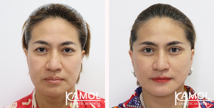 Before and After Full face lift, Neck lift