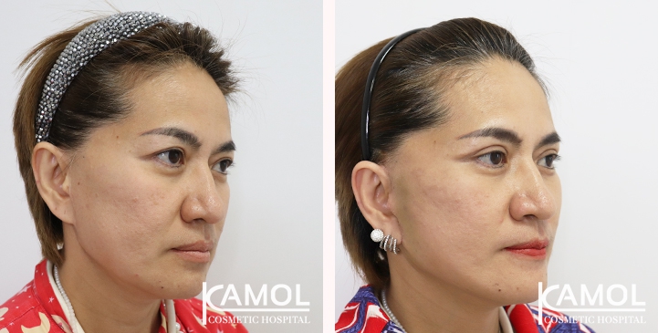 Before and After Full face lift, Neck lift