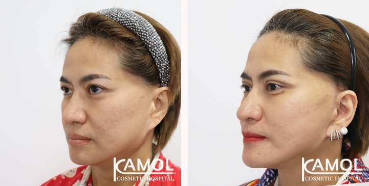 Before and After Full face lift, Neck lift