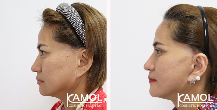 Before and After Full face lift, Neck lift