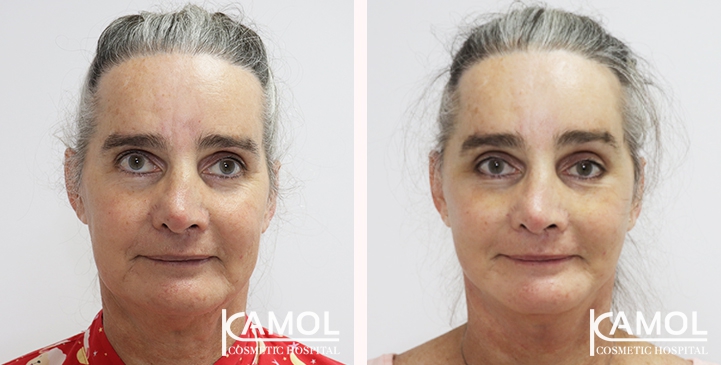 Before and After Full face lift, Neck lift