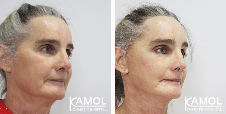 Before and After Full face lift, Neck lift