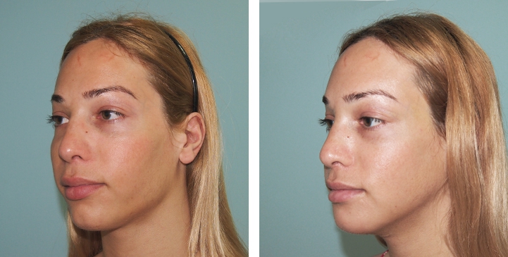 Before and After 1 month surgery, Forehead Compression, Chin Reduction, Jaw Reduction, Rhinoplasty