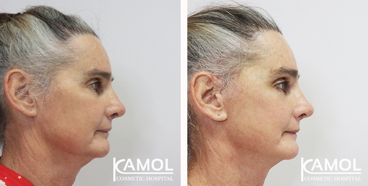 Before and After Full face lift, Neck lift