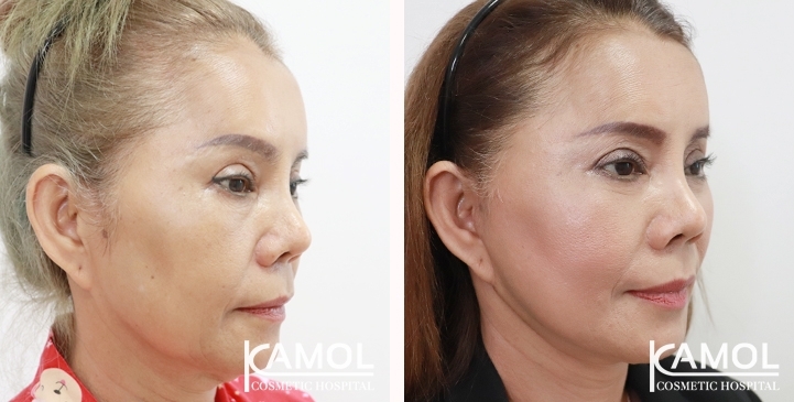 Before and After Full face lift, Neck lift