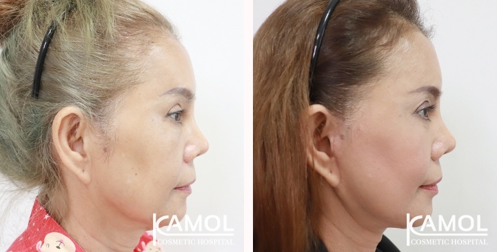 Before and After Full face lift, Neck lift