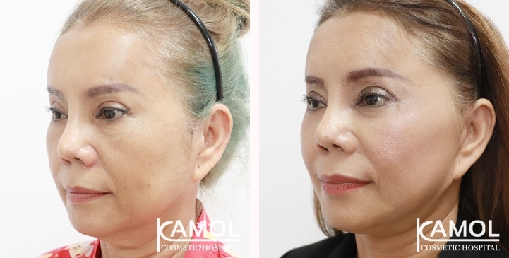 Before and After Full face lift, Neck lift