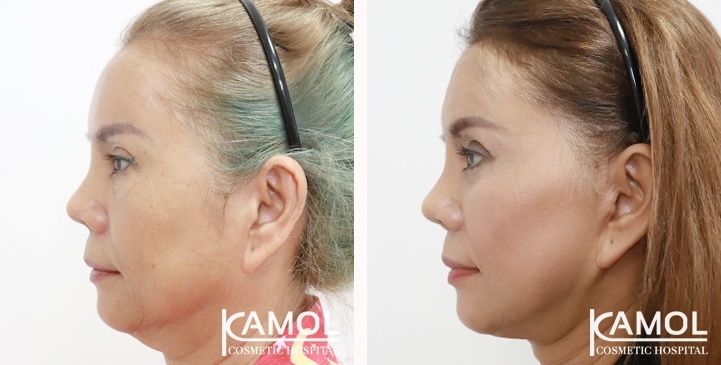 Estiramiento Facial  Kamol Cosmetic Hospital