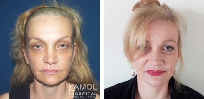 Before and After Face lift, Full face lift