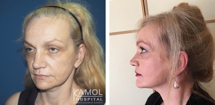 Before and After Face lift, Full face lift