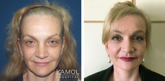 Before and After Face lift, Full face lift