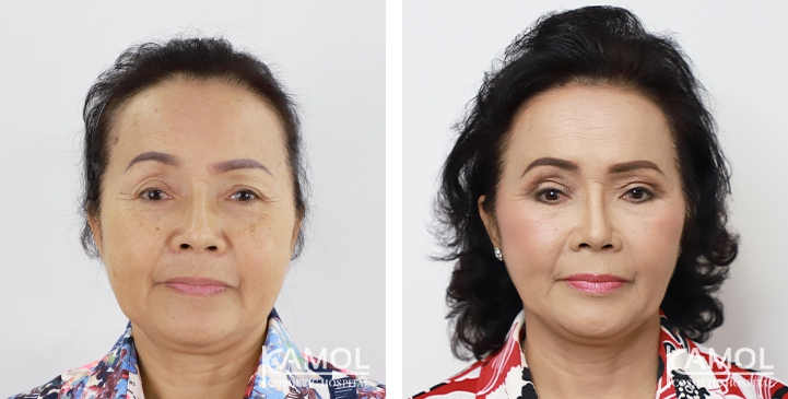 Before and After Full face lift, Neck lift