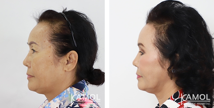 Before and After Full face lift, Neck lift