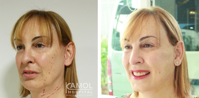 Before and After Full face lift, Neck lift