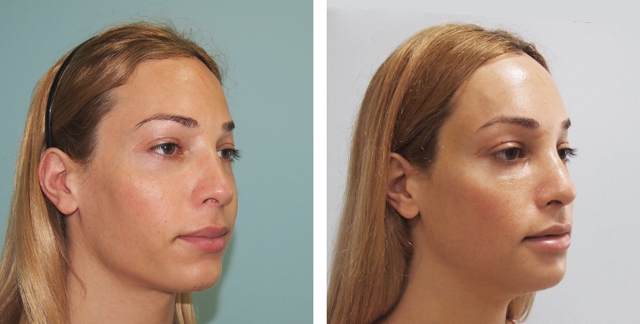 Before and After 1 month surgery, Forehead Compression, Chin Reduction, Jaw Reduction, Rhinoplasty