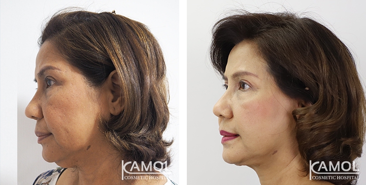 Before and After Full face lift, Neck lift