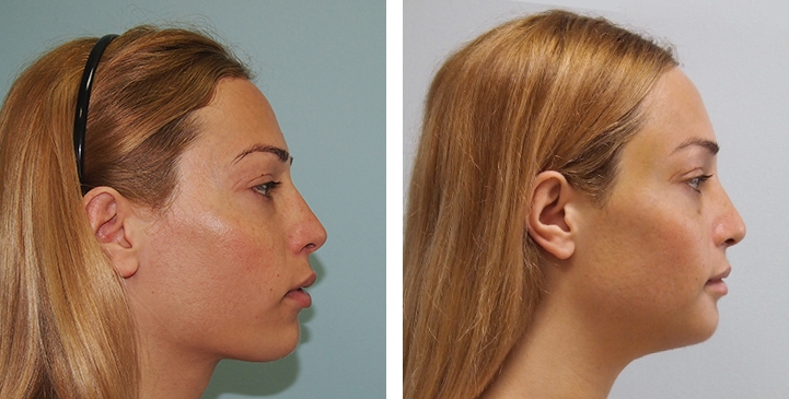 Before and After 1 month surgery, Forehead Compression, Chin Reduction, Jaw Reduction, Rhinoplasty