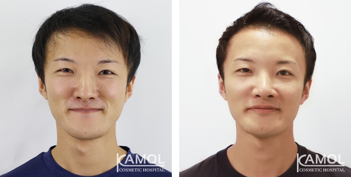 Before and After 1 month of Lower Mandibular Osteotomy, Corrective Jaw Surgery