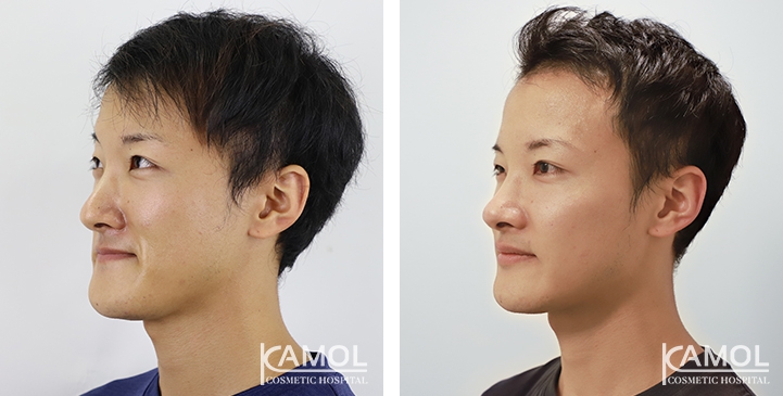 Before and After 1 month of Lower Mandibular Osteotomy, Corrective Jaw Surgery