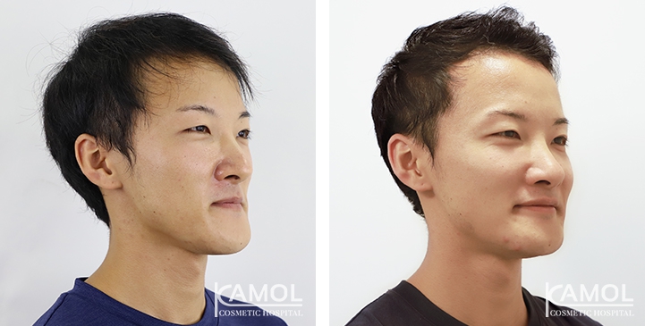 Before and After 1 month of Lower Mandibular Osteotomy, Corrective Jaw Surgery