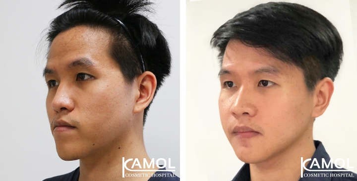 Before and After 1 month of Upper and Lower Mandibular Osteotomy, Corrective Jaw Surgery