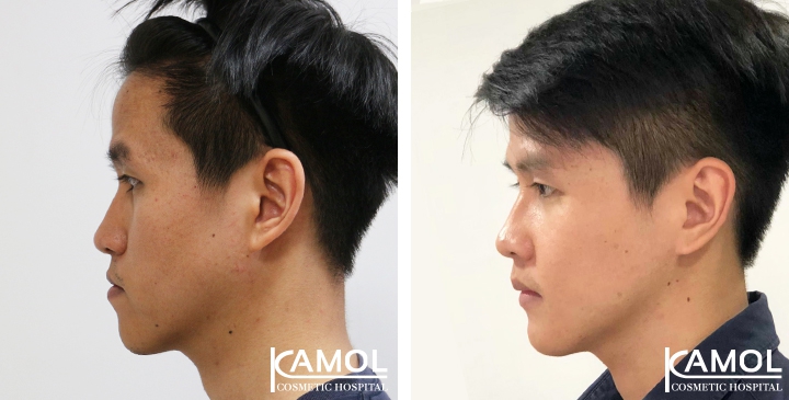 Before and After 1 month of Upper and Lower Mandibular Osteotomy, Corrective Jaw Surgery