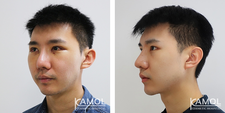 Before and After Jaw Augmentation