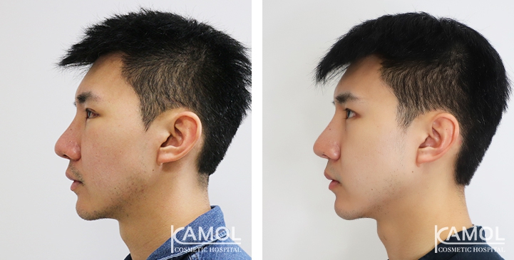 Before and After Jaw Augmentation