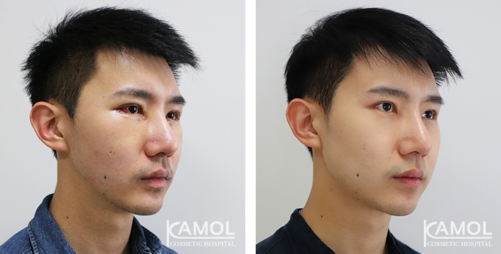 Before and After Jaw Augmentation