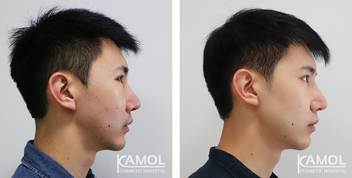 Before and After Jaw Augmentation