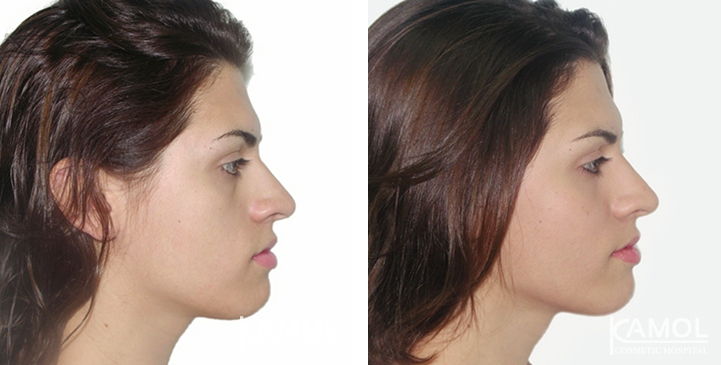 Before and After Jaw Augmentation