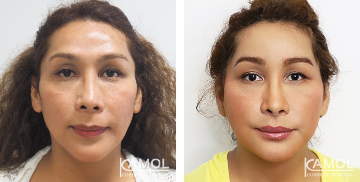 Before and After 1 month surgery,Uppder Lip Lift, Chin Reduction, Face Lift, Orbital Eyebone Shaving ,Forhead Augmentation