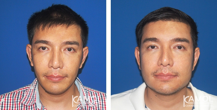 Before and After Jaw Augmentation