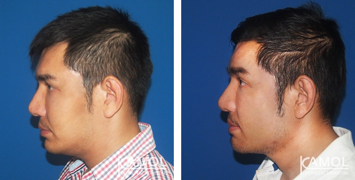 Before and After Jaw Augmentation