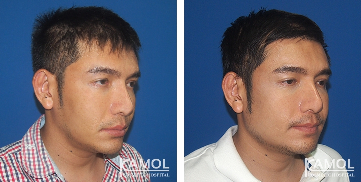 Before and After Jaw Augmentation